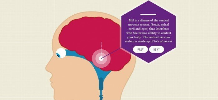 Un proyecto interactivo ayuda a entender la Esclerosis Múltiple
